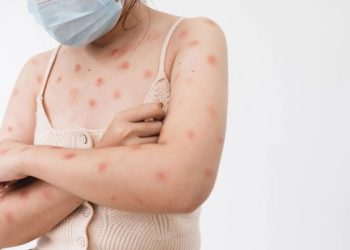 Sete casos suspeitos de Mpox são registrados em SC